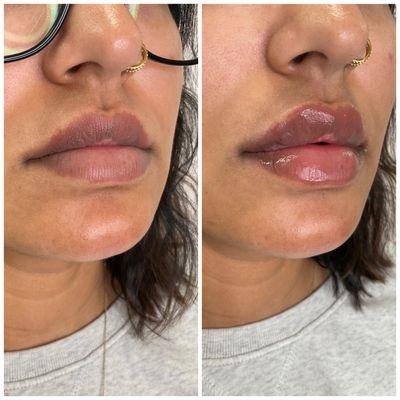 Lips using Versa. Natural yet plumper looking lips.