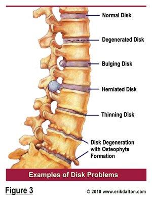 Poor posture can lead to bones rubbing on each other, potentially causing earlier degenerative changes.