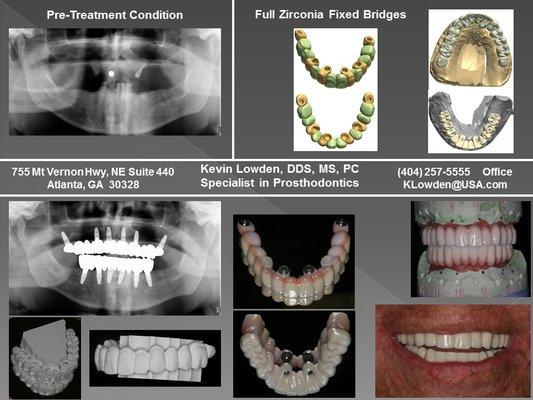 Dental Implant Reconstruction