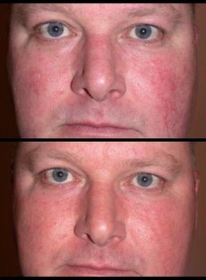 IPL Skin Rejuvenation Before & After (1st Session)