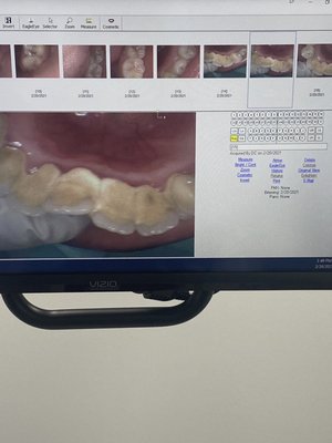 I'm embarrassed to say these are my before shots. I hated the dentist because of all this discomfort I experienced in the past.