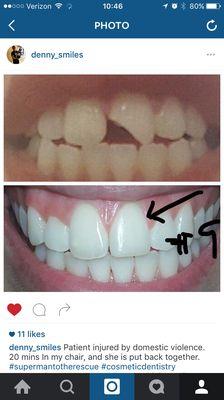 Broken tooth?  No problem we were able to repair with a filling.  Work Done by Dr Dennis Rivera.