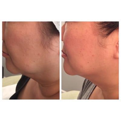 Thermatrix -Lift, firm & rebuild collagen