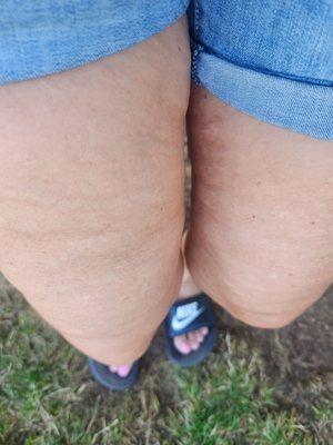 My legs after receiving just one cellulite treatment