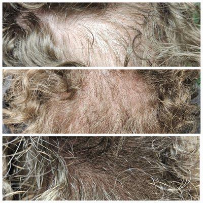 Platelet-rich fibrin (PRF) hair restoration a non-surgical, minimally invasive treatment that stimulates hair growth