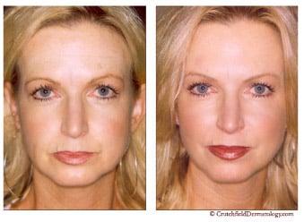 Botox & Dermal Filler Non Surgical Face Lift