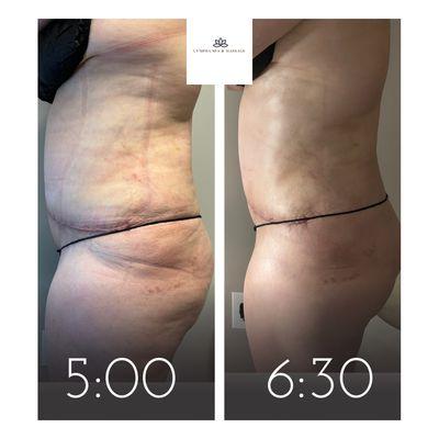 Post Tummy Tuck and Lipo Massage