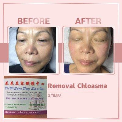 REMOVAL Chloasma 3 TIMES