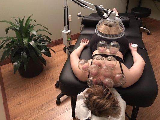 Dr. Chang's Cupping Procedure