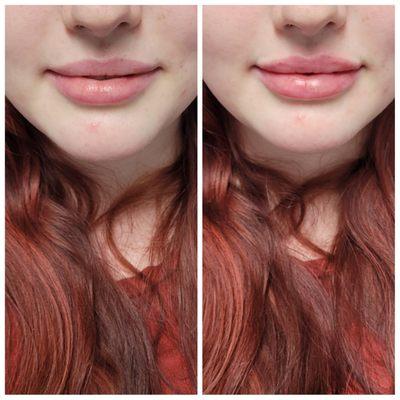 Before and after lip filler treatment!