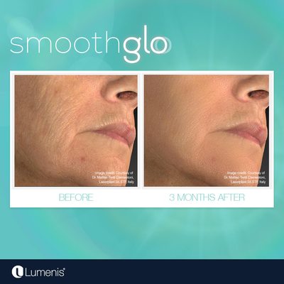 Skin rejuvenation by Smoothglo