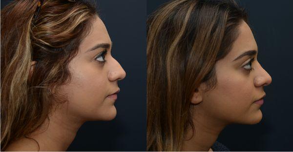 Rhinoplasty Before and After