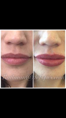 1 syringe of Juvederm right after