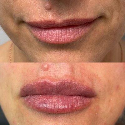 Before & After - Filler