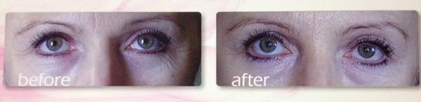 We offer a wide range of aesthetic eye lid treatments including non-surgical lid lifts using Viora Reaction