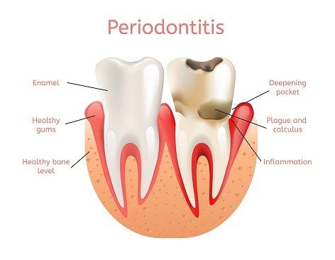 Periodontitis