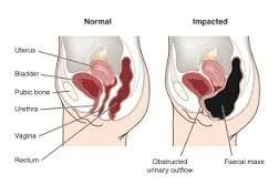 Here, a side view of  internal organs as it relates to the Large Intestine. A person that doesn't have a "complete bowel movement" On right