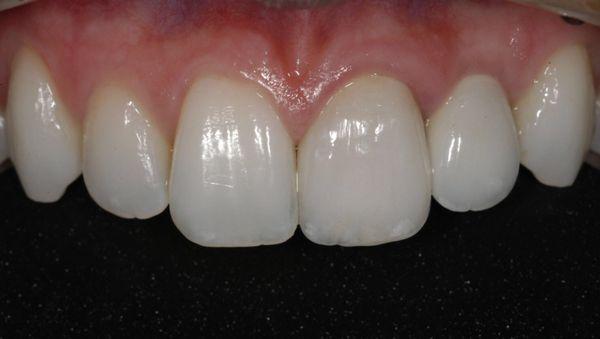 Beautiful implant crown on an implant