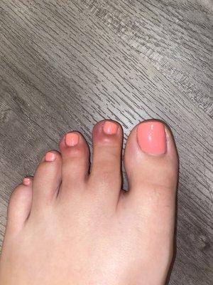 Toe infection