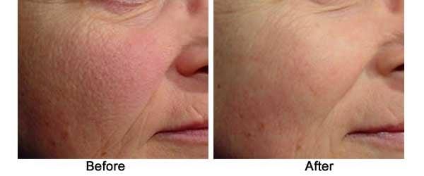 Glycolic Peel Before/after pict