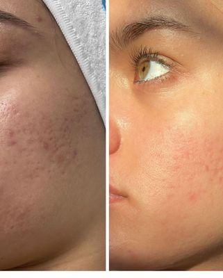 SQT Biomicroneedling resurfacing.