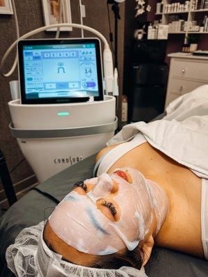 Potenza RF microneedling