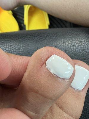 cuticle cut