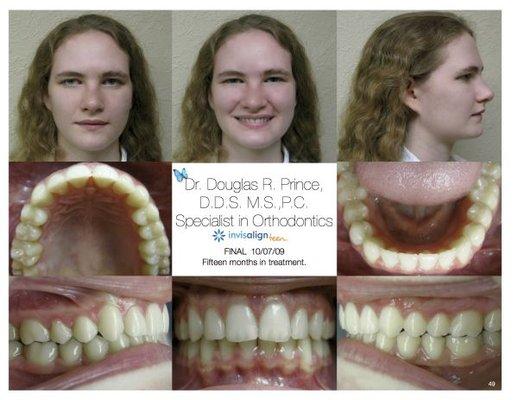 Severe crowding - After Invisalign Teen