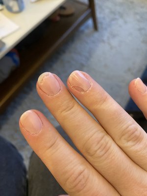 SNS chipped after 2 days