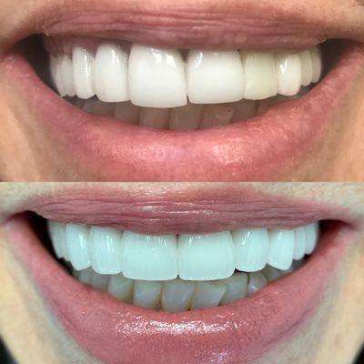 Front teeth porcelain crowns and implant. Before and after.