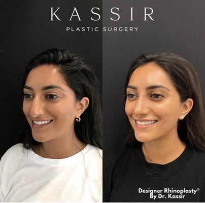 After Designer Rhinoplasty®