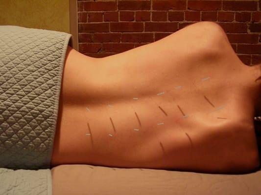 Acupuncture at OMBE