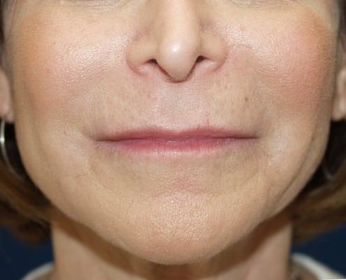 Rosenthal Liquid Facelift: After 55 year old.  Radiesse for cheeks and jaw & Juvederm around the mouth.