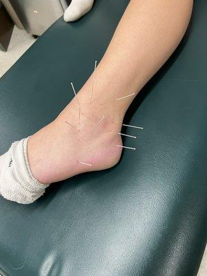 If you deal with ankle pain from an old injury or new one, dry needling can clear that up! Call for more info!