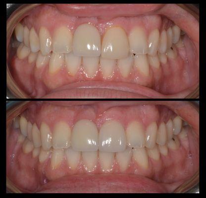 Replacement of a single veneer to match the existing implant crown on the other front tooth