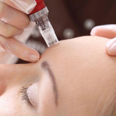 Microneedling