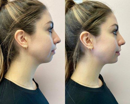 Balancing an already gorgeous profile with filler in the chin.