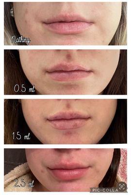 My filler journey. Just got another ml!