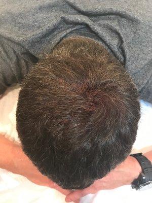 Scalp Micropigmentation AFTER