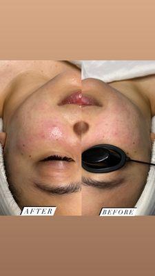 Microdermabrasion Treatment