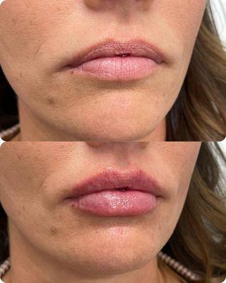 Lip Filler