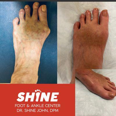 6 months after Bunion Correction Surgery. Great correction and minimal scar.