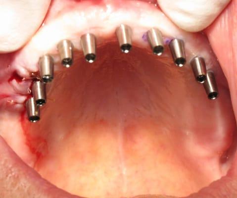 Dental Implants placed for Reconstruction of Upper Teeth 