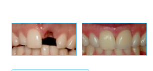 Before & After Our Dental Procedures!
 
 Before: Patient needs a Single Tooth Replacement of one Upper Central Incisor.