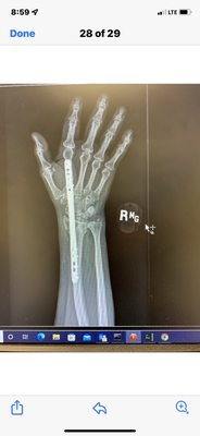 NO CAST NEEDED!!! TITANIUM PLATE SCREWED INTO FINGER AND WRIST TO "STABILIZE" BROKEN WRIST