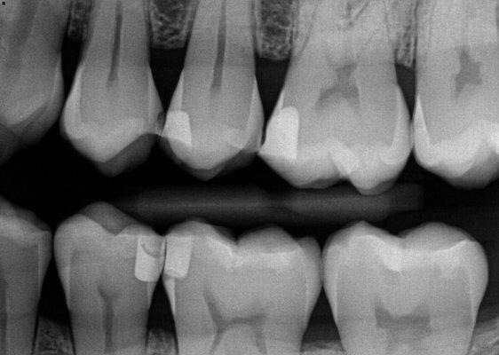 Chipped adjacent tooth