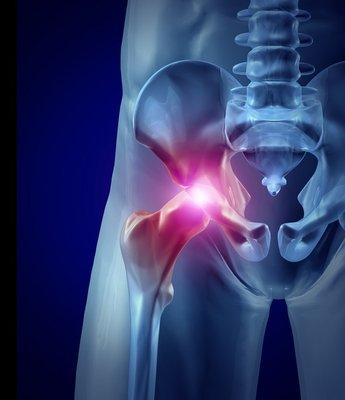 Corpus Christi hip replacement alternatives