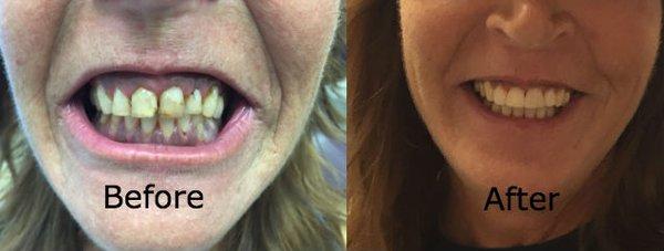 Before and after pictures of one of Dr. Orlandini's cosmetic dentistry patients.