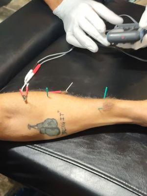 Got electrodes with dry needling today and it didnt even hurt. Doctor Utash is very good at what he does!