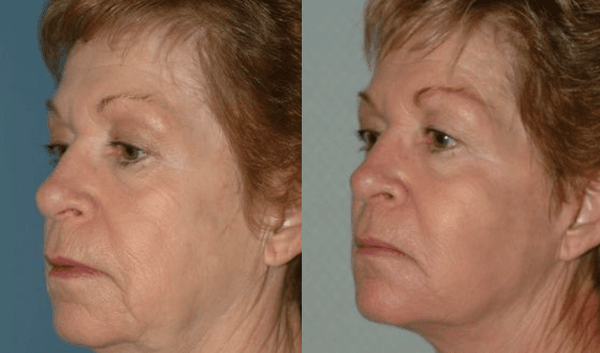 Before & After Results at The Center for Cosmetic Medicine | Monticello, IL